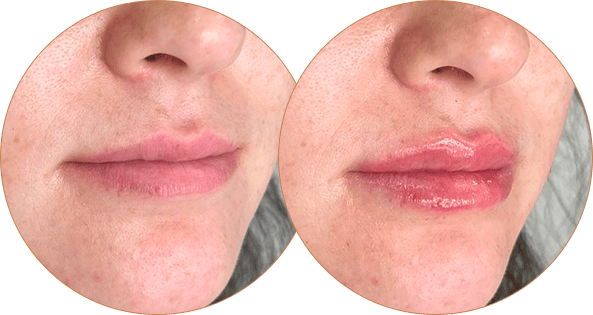 Before-After Photos LIPS